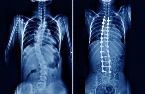 How Much Do You Know About Lumbar Spine Surgery?