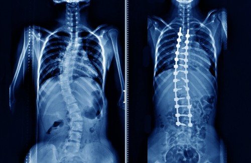 How Much Do You Know About Lumbar Spine Surgery? - Hosmat Hospital