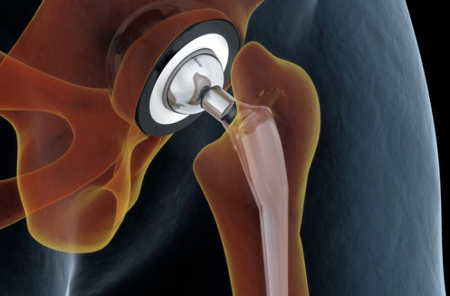 Is Age a Consideration for Joint Replacement?