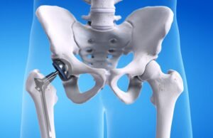 What is a total hip replacement