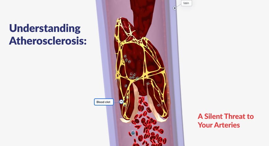 Understanding Atherosclerosis: A Silent Threat to Your Arteries