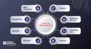 Atherosclerosis Causes